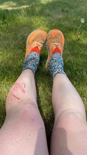 at first, my shin looked worse than my ankle